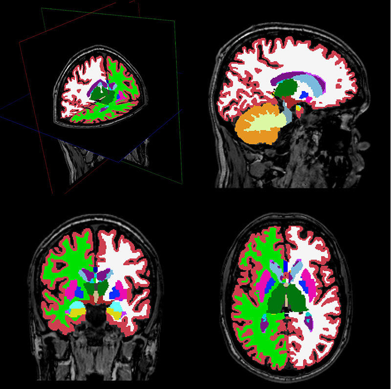 Imágenes del cerebro usadas en el estudio