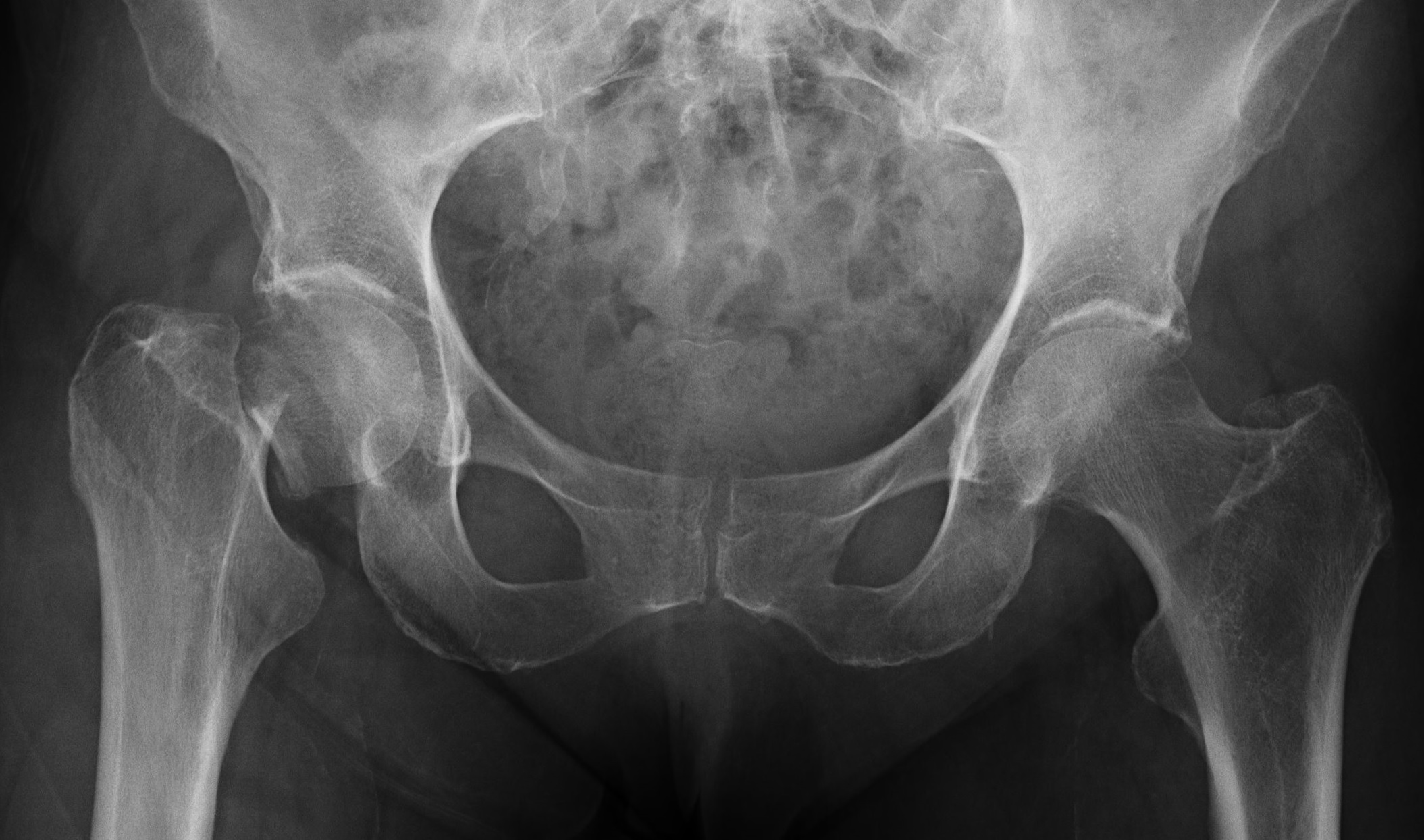 La osteoporosis puede llegar a producir fracturas de hueso